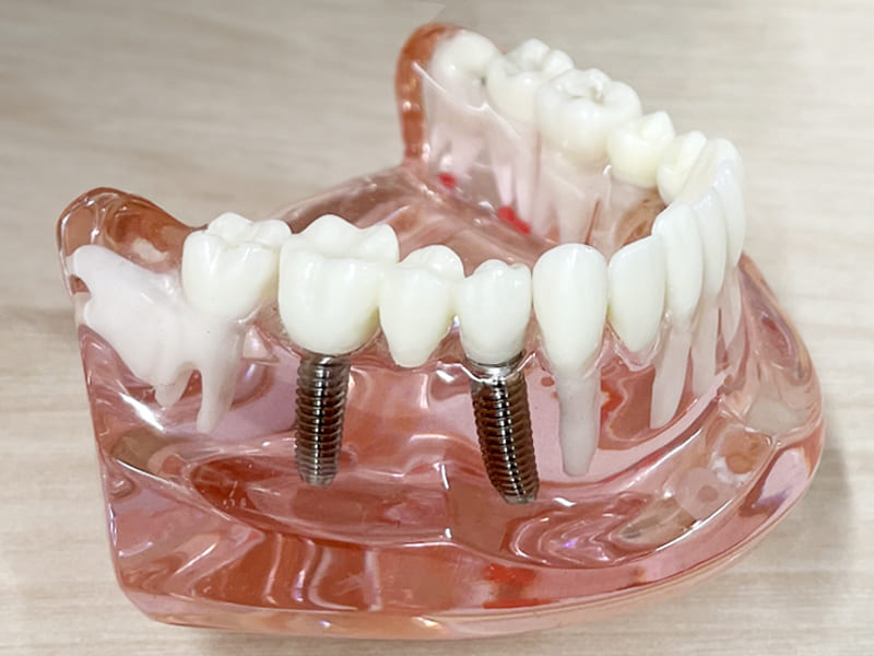 インプラントイメージ